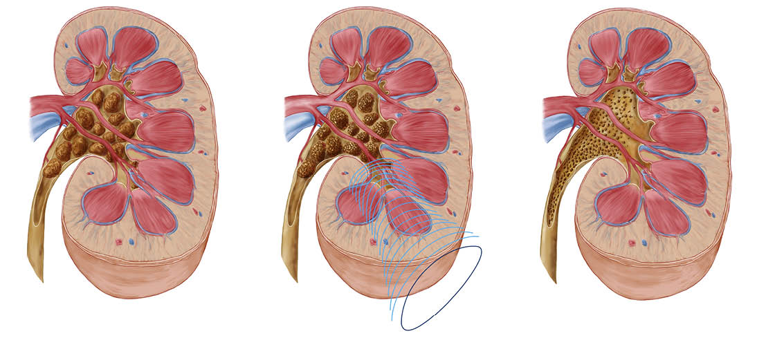 Comparison of different sized kidney stones in the human kidney. The middle image shows the use of extracorporeal shock wave lithotripsy to break up the stones.