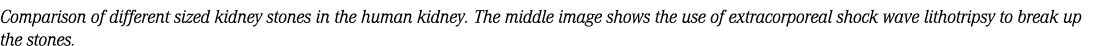 Comparison of different sized kidney stones in the human kidney. The middle image shows the use of extracorporeal sho...